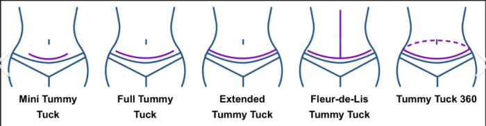 Best Surgery Tummy Tuck treatment in India