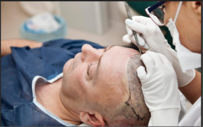 Best Surgery for Hair Transplant Treatment in India