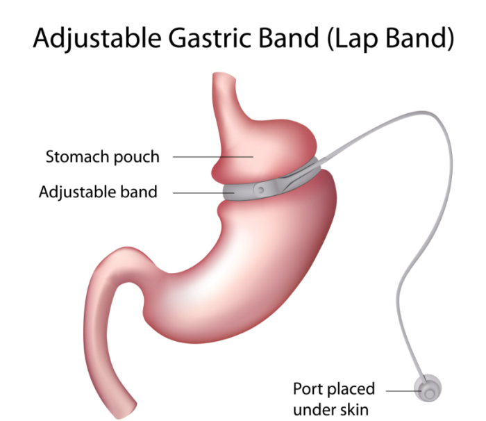  Best Laparoscopic Adjustable Gastric Banding (LAGB) treatment in India