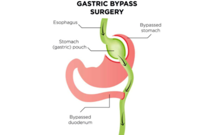 Best Surgery for Roux-en-Y Gastric Bypass (RYGB) Treatment in India