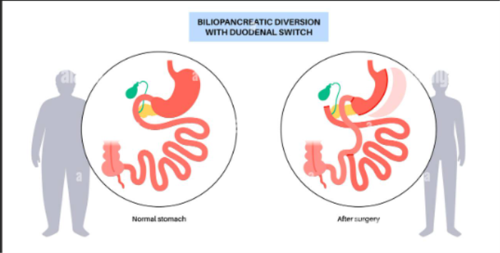 Best Biliopancreatic Diversion with Duodenal Switch (BPD/DS) Hospitals in India