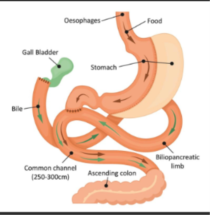 Biliopancreatic Diversion with Duodenal Switch BPD DS Surgery in India