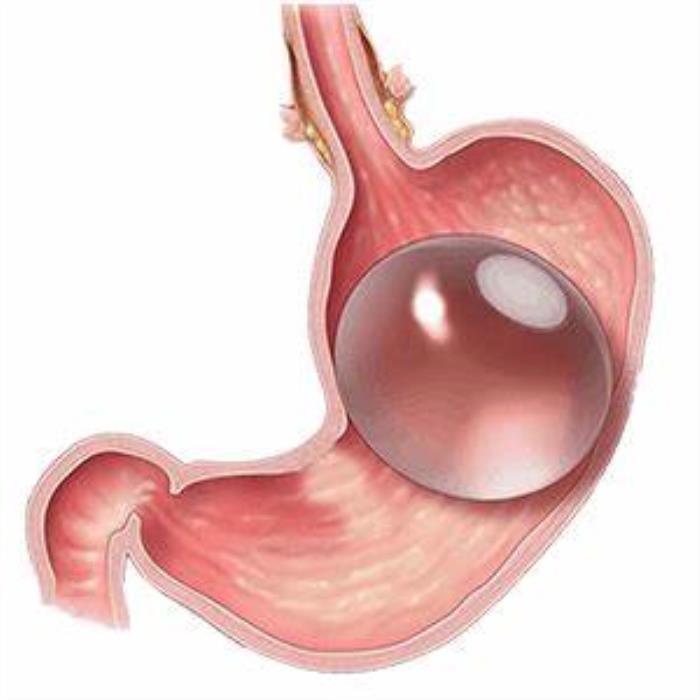 Preparing for Intragastric Balloon Treatment