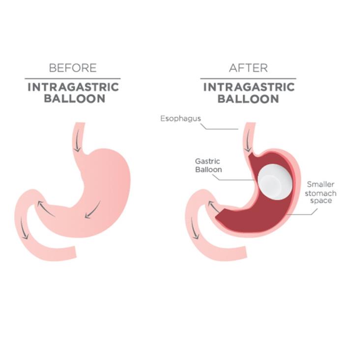 Best treatment for Intragastric Balloon in India