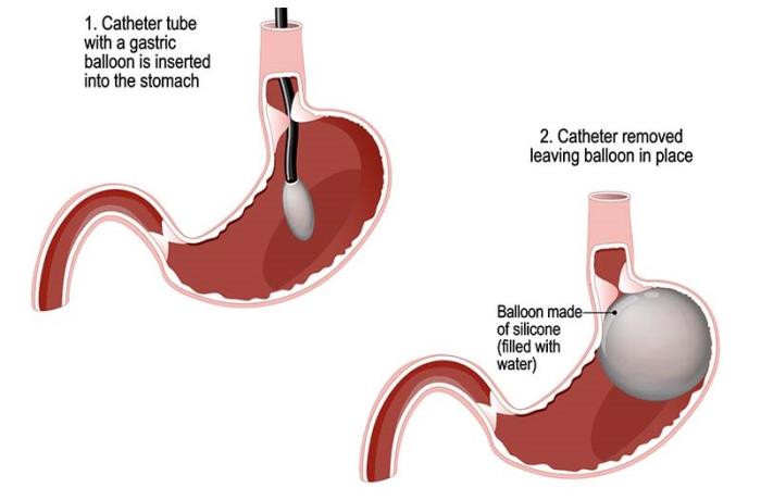  Best hospitals for Intragastric Balloon Treatment 