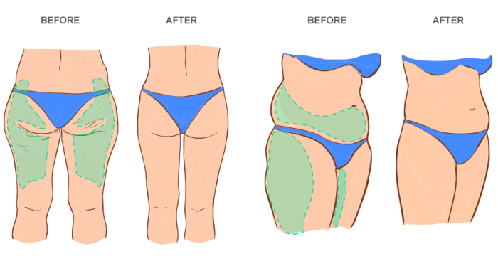 Best treatment options for full body lift surgery in India