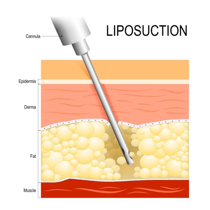 Different types of liposuctions in india