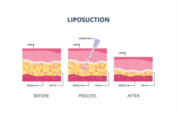 Treatment options for liposuctions in india