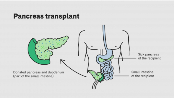 Common Post-Surgery Complications After Pancreas Transplant