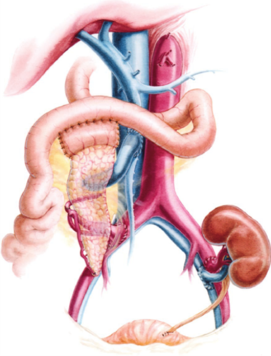 Kidney Function Monitoring Post-Simultaneous Kidney-Pancreas Transplant