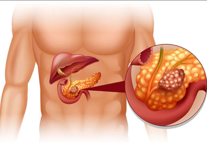 Innovative Approaches to Managing Pancreatic Disorders without Surgery