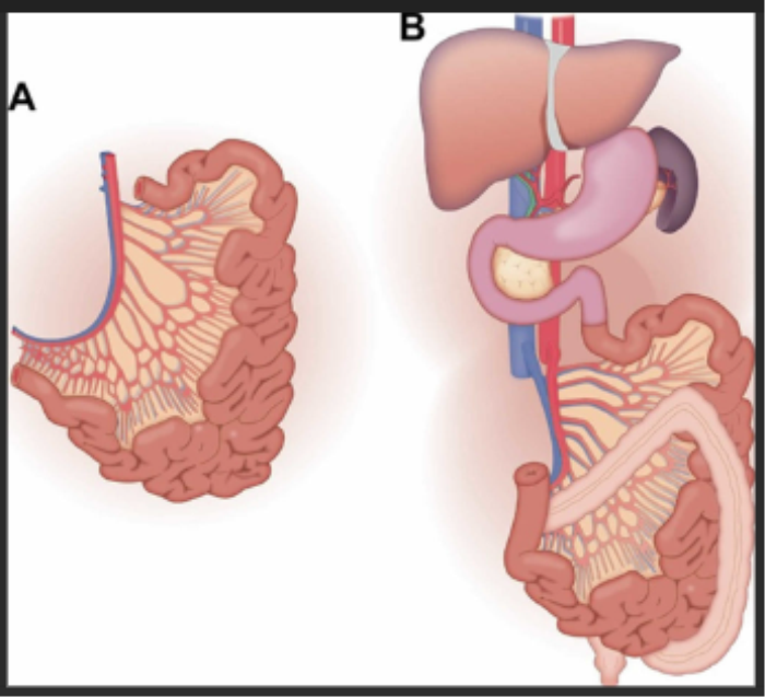 Understanding Intestine Transplant