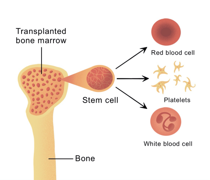 What Are Stem Cells and Why Are They Essential in Bone Marrow Transplants?