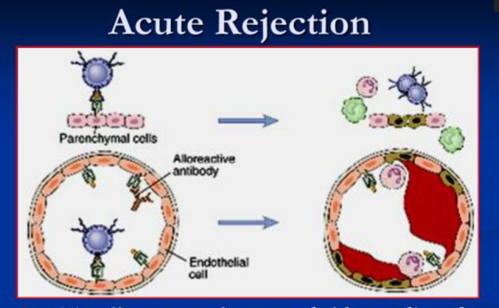 Acute Rejection