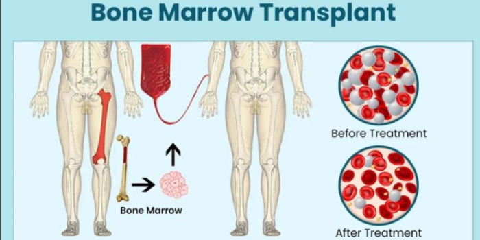 What is Bone Marrow Transplantation?