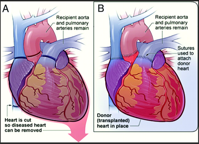 Heart Transplant in India