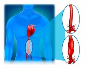 Recognizing the Symptoms and Causes of Abdominal Aortic Aneurysm