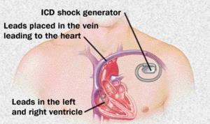 Understanding the Risks of Infection Post-AICD Surgery