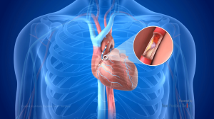 Common Causes Leading to Heart Bypass Surgery