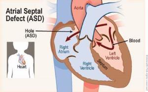 Risks and Complications Associated with ASD Closure Surgery