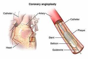 Risks and Complications of Coronary Angioplasty