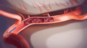 The Role of Cholesterol Management in Preventing Aneurysms