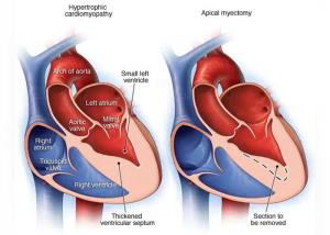 Causes of Patent Ductus Arteriosus and What Leads to the Condition