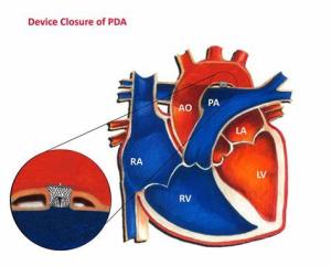 PDA Device Closure and Its Impact on Heart Function Over Time