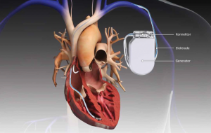 Risks and Complications of Pacemaker Surgery