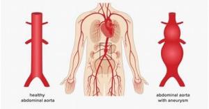 How Diabetes Affects the Risk and Treatment of Abdominal Aortic Aneurysm