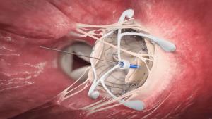 Risk Involved in Mitral Valve Replacement Surgery