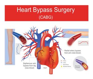 Life After Heart Bypass Surgery What to Expect