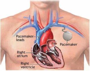 Symptoms Indicating the Need for Pacemaker Implantation