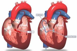 Risks and Complications of VSD Surgery What to Expect