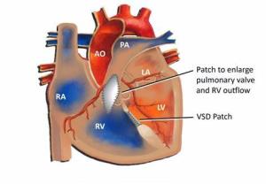 Innovations in Tetralogy of Fallot Surgery: Latest Advances in Treatment