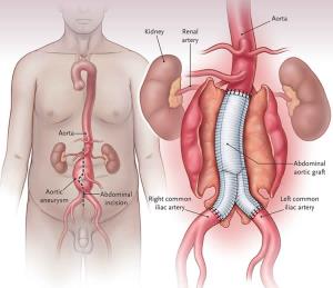 Life After Abdominal Aortic Aneurysm Surgery