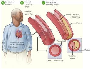 Understanding the Causes of Coronary Artery Disease