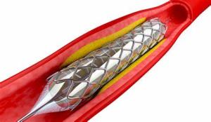 Exploring the Latest Research in Coronary Angioplasty