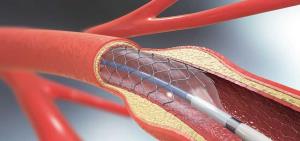 Understanding the Role of Imaging Techniques in Angioplasty