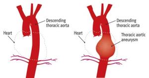 Understanding Aneurysm Size and Its Impact on Treatment Decisions