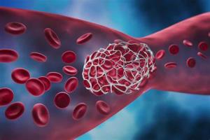 The Role of Anticoagulants After TAVR Surgery