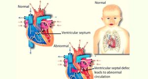 How VSD Surgery Affects Growth and Development in Children