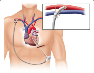 Signs of Left Ventricular Assist Device Malfunction and When to Seek Help