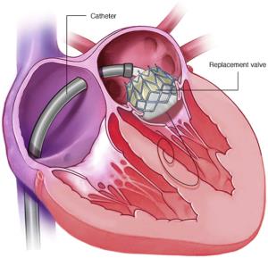 Latest Advancements in Mitral Valve Disease Treatment