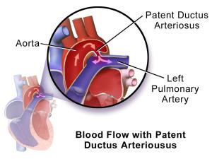 Risks Involved in Patent Ductus Arteriosus Complications and Long term Effects