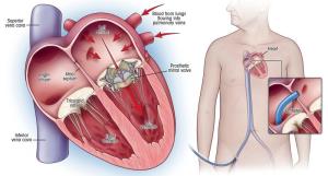 Understanding the Risks of Delaying Heart Valve Replacement Surgery