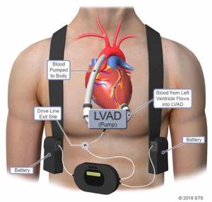 Best Left Ventricular Assist Device Surgery Hospitals in India