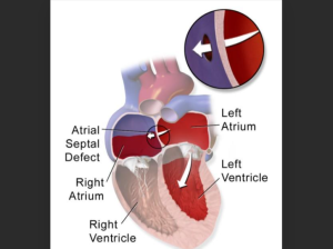 Best ASD Closure Surgery Hospitals in India