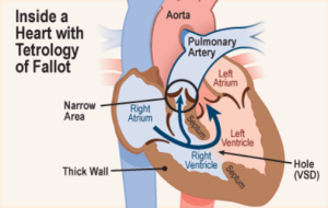 Best Tetralogy of Fallot (TOF) Surgery Hospitals in India