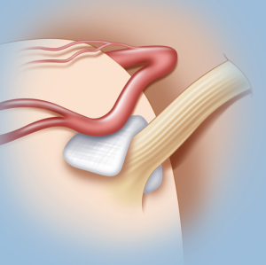 Strategies to Minimize Scarring and Recovery Time after Trigeminal Neuralgia Surgery